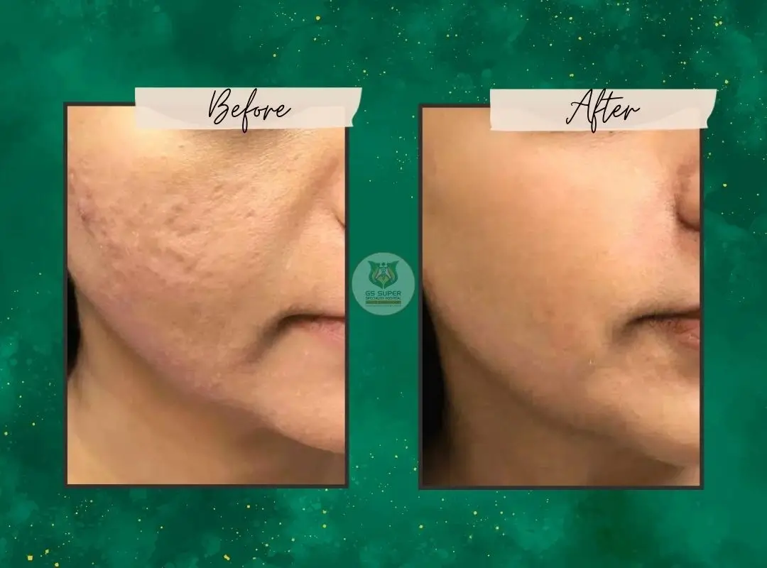 Before and After Treatment 1