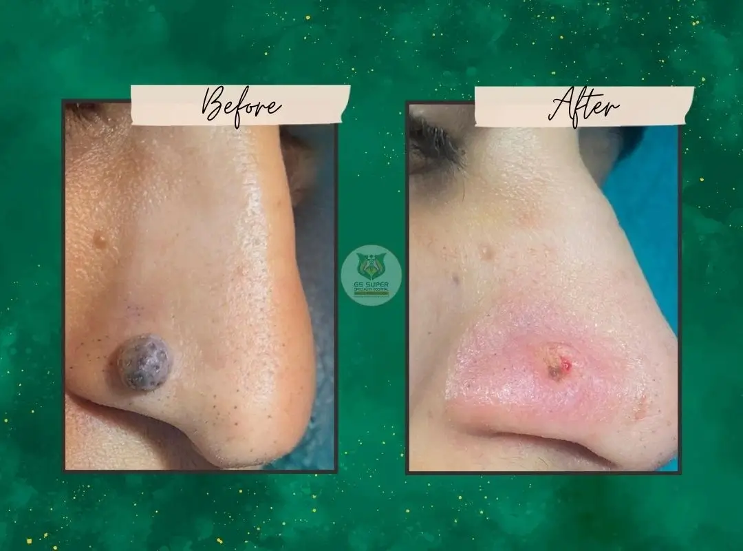 Before and After Treatment 2