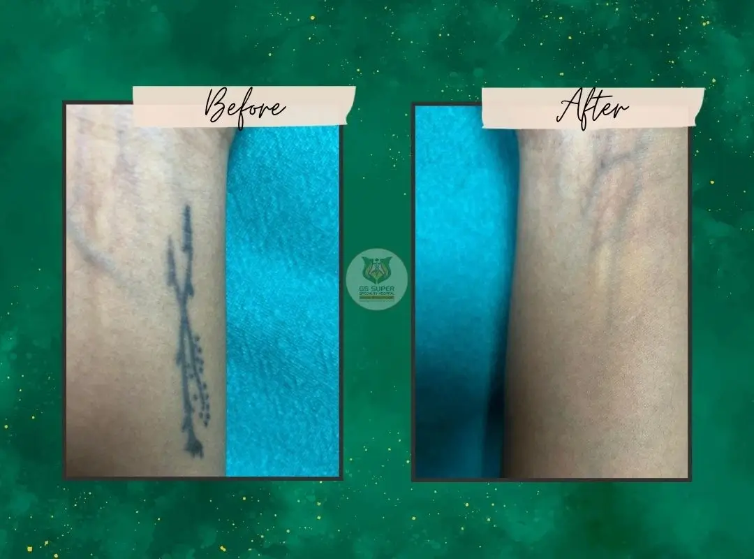 Before and After Treatment 3
