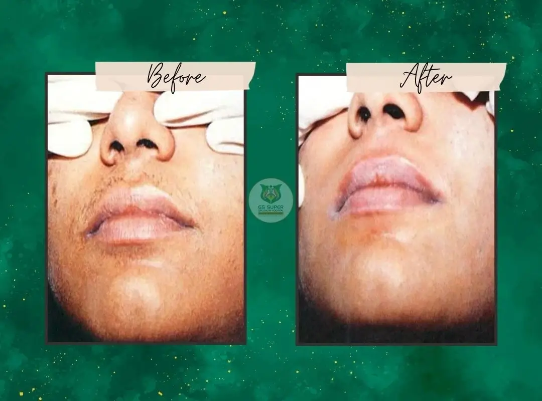 Before and After Treatment 4