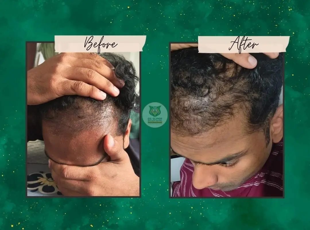 Before and After Treatment 5